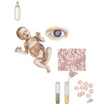 Galactosemia