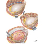 Myocardial Revascularization by the Vineberg and the Sewell Technique