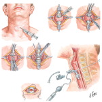 Tracheostomy