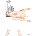 Cardiac Catheterization