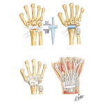 Implant Resection Arthroplasty for Radiocarpal Joint