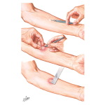 Tuberculin Testing