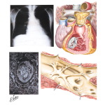 Chronic Effects of Pulmonary Embolism (Cor Pulmonale)