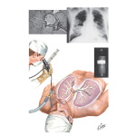 Alveolar Proteinosis