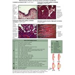 Implant Resection Arthroplasty for Proximal Interphalangeal Joint