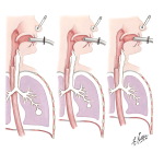 Measurement of Elastic Properties of Lung