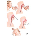 Bronchography: Technique