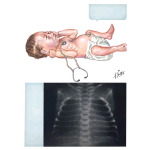 Clinical Manifestations of Hyaline Membrane Disease