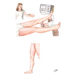 Radioactive Fibrinogen Scan for Diagnosis of Leg Vein Thrombosis