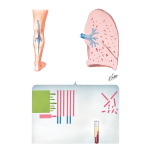 Fibrin Degradation Products (FDP) in Diagnosis of Pulmonary Emboli