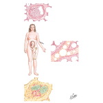 Extravascular Sources of Pulmonary Emboli