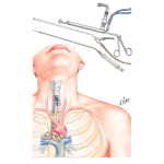 Mediastinoscopy