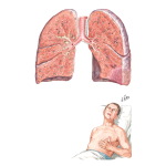 Pulmonary Infarction