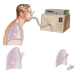 Maximal Expiratory Flow-Volume Curve