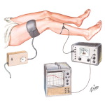 Plethysmography in Diagnosis of Leg Vein Thrombosis