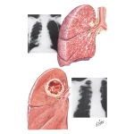 Lymphangitic Spread of Cancer in Lung