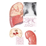 Nocardiosis