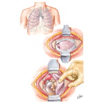 Mediastinotomy