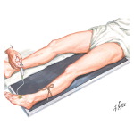 Phlebography for Diagnosis of Leg Vein Thrombosis (Venography)