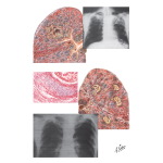 Silicotuberculosis