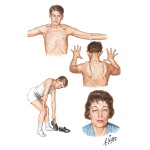 Other Types of Muscular Dystrophy