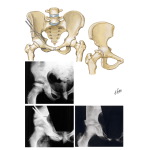 Innominate Osteotomy