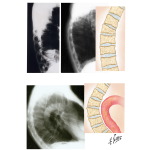 Radiographic Findings in Axial Osteoporosis
