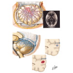 Vascular Malformations