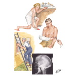 Myopathies Secondary to Endocrine Disorders