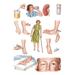 Peripheral Neuropathies: Metabolic, Toxic and Nutritional