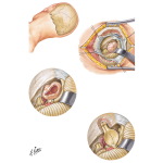 Removal of Acoustic Neurinoma: Posterior Fossa Approach