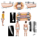Wagner Technique for Limb Lengthening