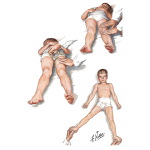 Physical Examination In Legg - Calve - Perthes Disease