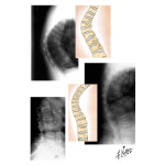 Radiographic Findings In Axial Osteoporosis