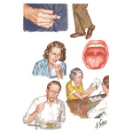 Motor Neuron Disease: Early Clinical Manifestations