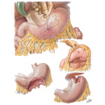 Trauma of Stomach