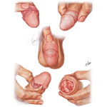 Warts, Precancerous Lesions, Early Cancer