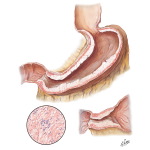 Carcinoma of Stomach