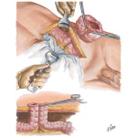58116		5	Pancreas	Consequences of Insulin Deprivation	137																																																																																																																																																																																																																																																						