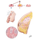 Chronic Cystic Mastitis I - Mastodynia