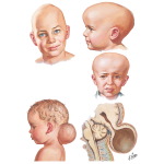 Craniosynostoses and Encephalocele