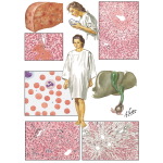 Liver Disease in Pregnancy