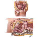 Abdominal Wounds IV - Rectum