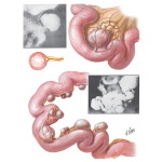 Diverticula of Small Intestine