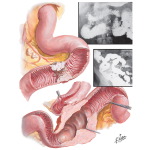 Malignant Tumors of Small Intestine I and II