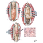 Spinal Cord Tumors