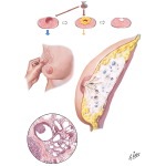 Chronic Cystic Mastitis II - Adenosis