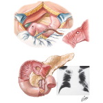 Peptic Ulcer VIII - Complications of Gastric and Duodenal Ulcers