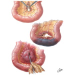 Abdominal Wounds II - Mesentery