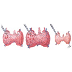 Effect of Antithyroid Drugs on Gland Structure